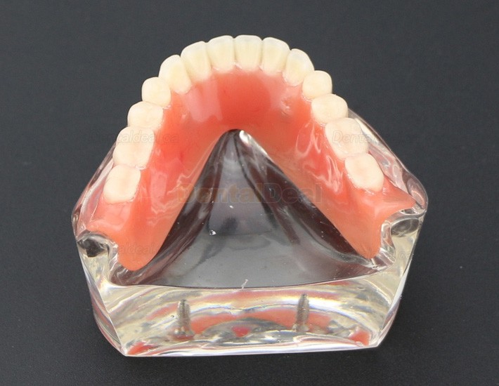 Dental Teeth Implant Overdenture Model Lower Jaw with 2 Implants Education Study Demo Model 6002 01